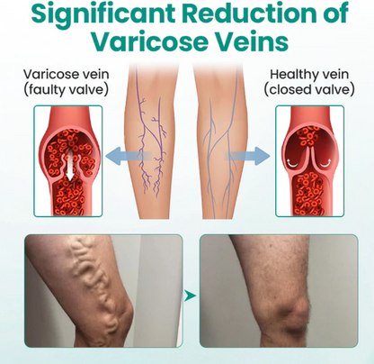 Varicose Vein Relief Patch